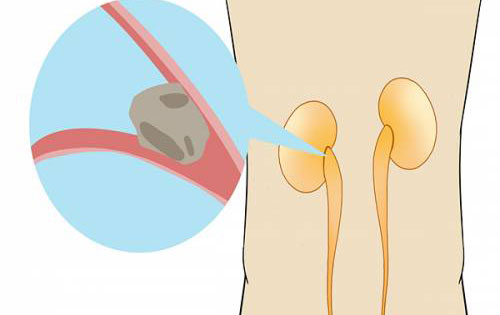 ����ʯ������֢״ ������Щ�����������ʯ